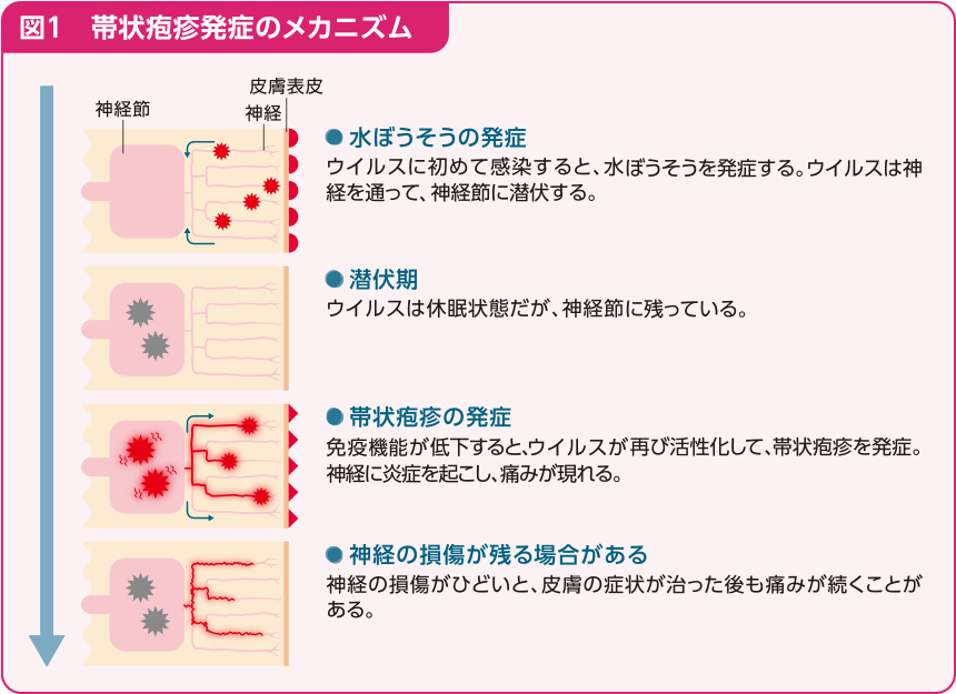 図1、帯状疱疹発症のメカニズム