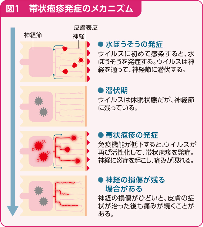 図1、帯状疱疹発症のメカニズム