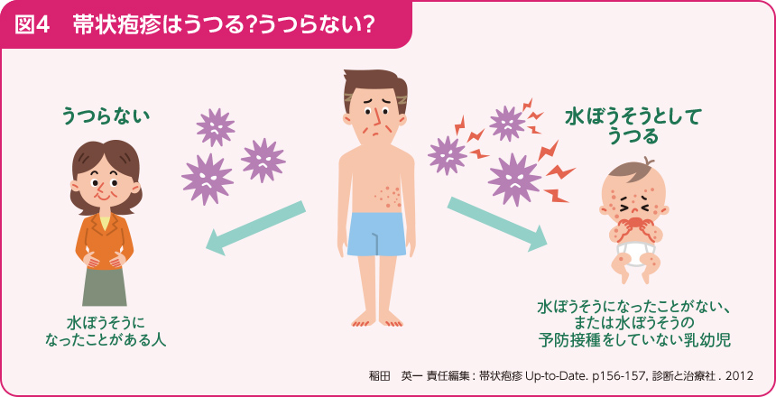 図4、帯状疱疹はうつる？うつらない？