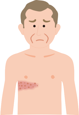右胸背部に帯状疱疹が発症した男性イラスト