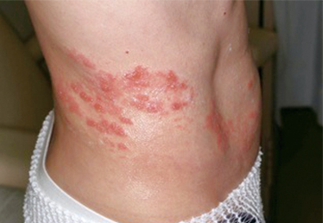 右腹背部にあらわれた帯状疱疹の写真